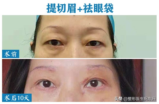 眼皮老是耷拉着睡不醒？恢复年轻其实并不难！