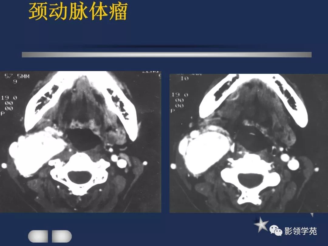 腮腺疾病影像学诊断,腮腺肿块影像诊断