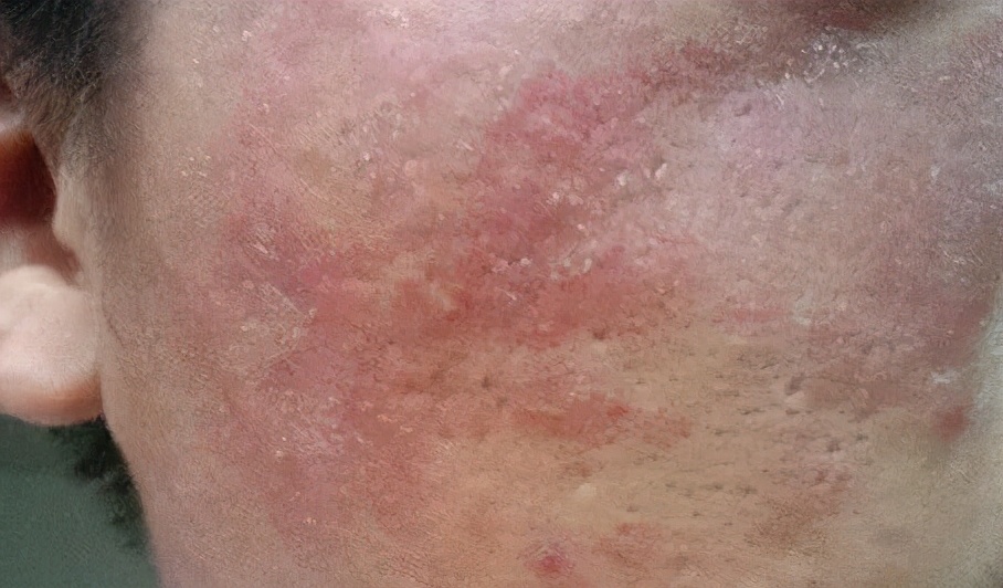 皮肤总是出油而且很黄,皮肤总是出油但起皮