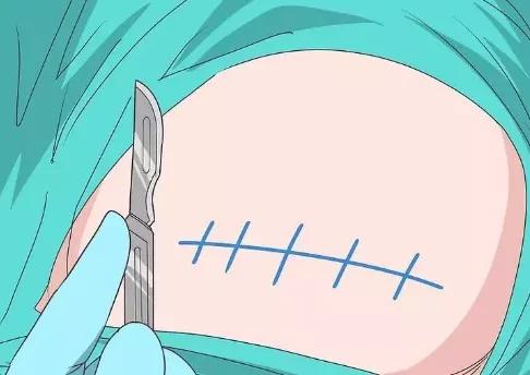 郑嘉颖老婆两年剖两胎？这样很危险