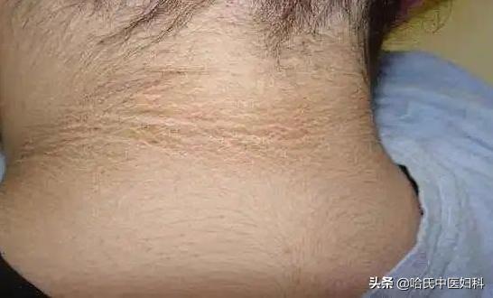 为什么好多年轻女性多囊,多囊女孩怎么回事