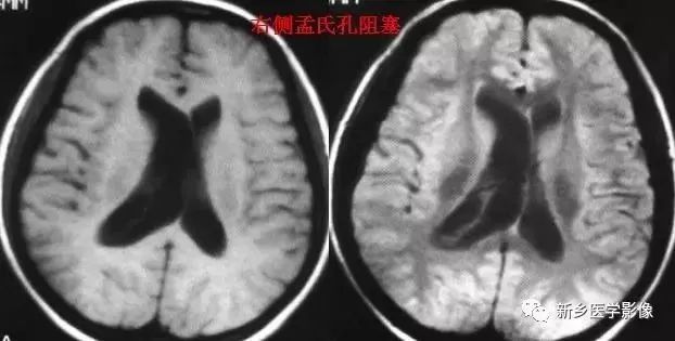 脑室影像学表现,脑室占位影像