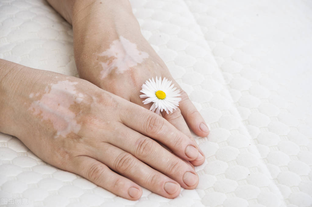 成年人白斑如不及时治疗会有哪些后果