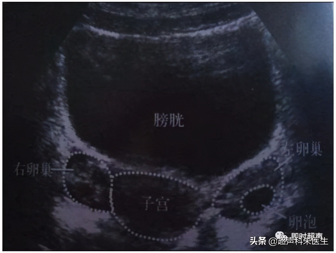 妇科超声的标准超声图,妇科超声图解