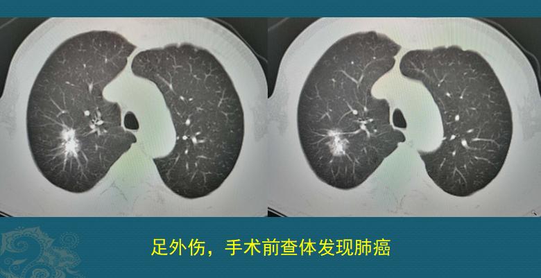 听诊器能听出早期肺癌吗,医生听诊器能听出肺癌吗