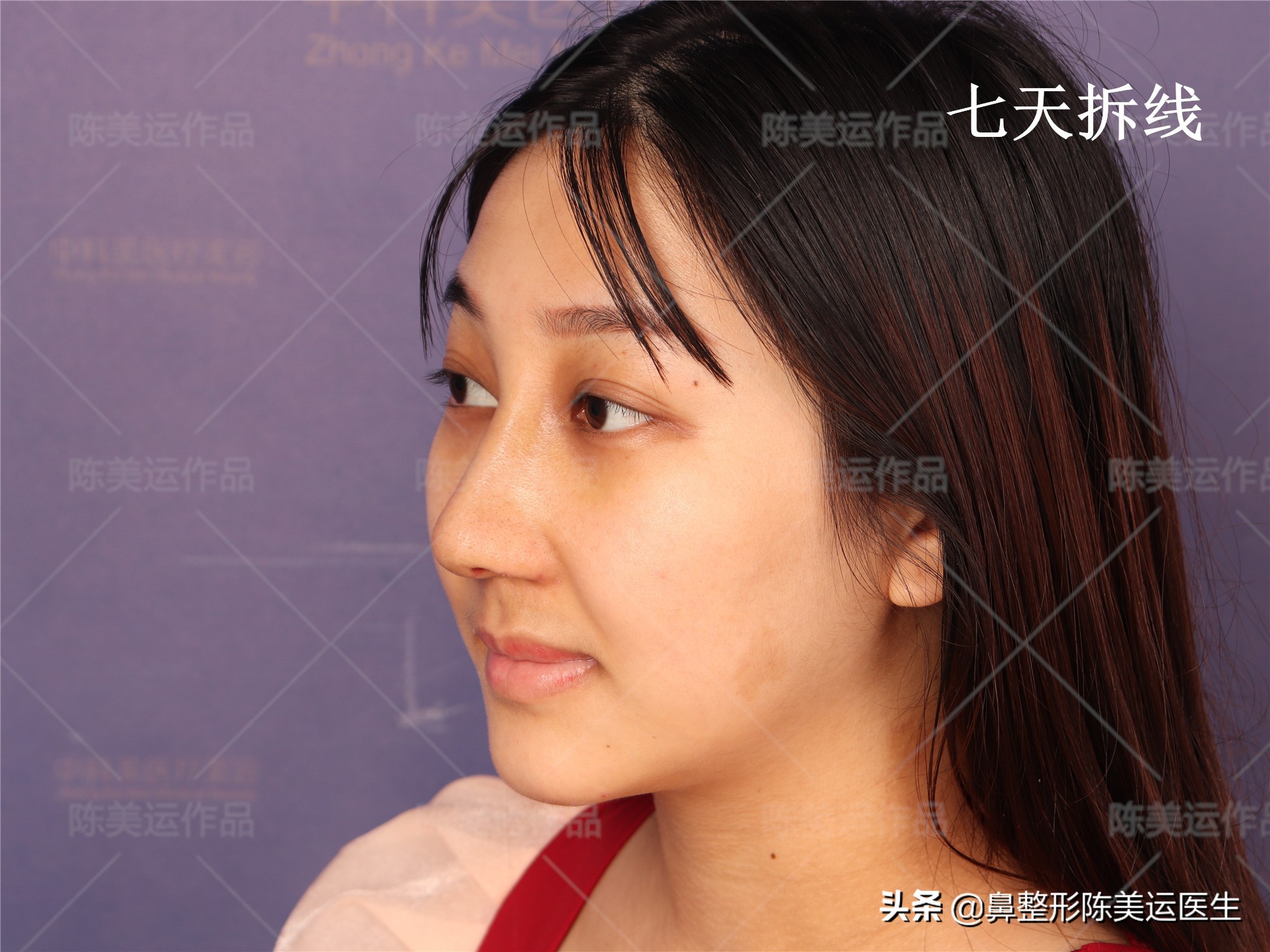 线雕隆鼻失败的图片,线雕隆鼻失败