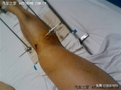 外固定多久恢复,外固定取出一般多久