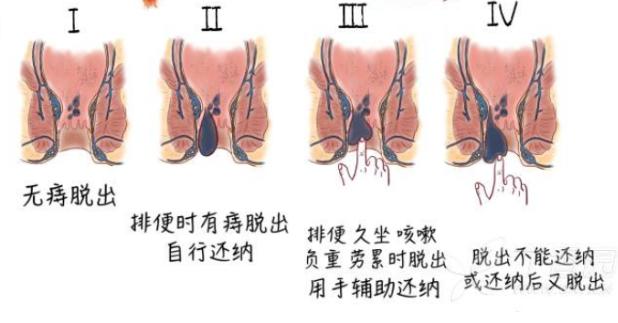 痔疮便血自愈的秘诀,一级痔疮能不能自愈