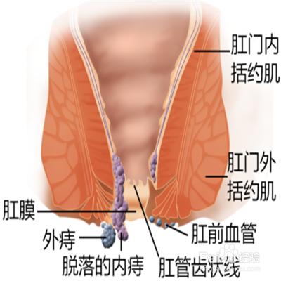 痔疮手术预防使用抗菌药物,得了痔疮如何才能预防不动手术