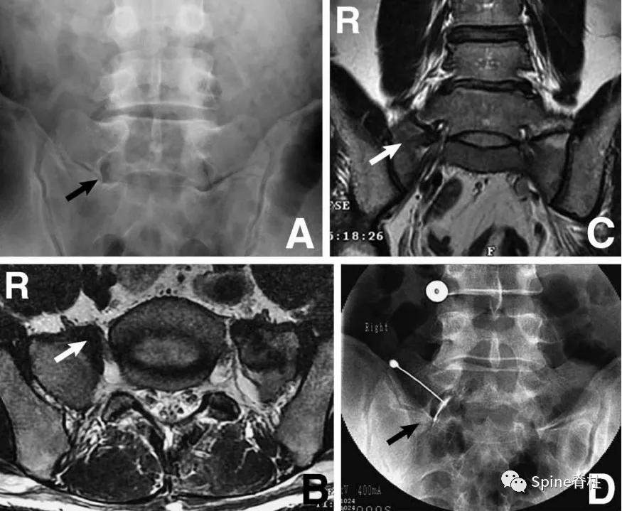 下肢疼痛是腰椎间盘突出引起的吗,下肢放射痛查不出原因