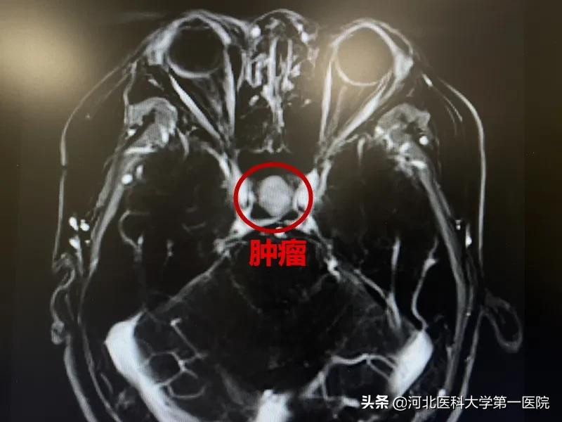 神奇魔法刀，一点就消！点亮肿瘤绝境患者，再生的希望之光