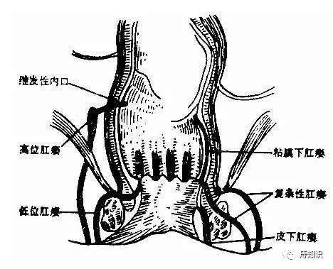 肛瘘会癌变吗,高位复杂肛瘘