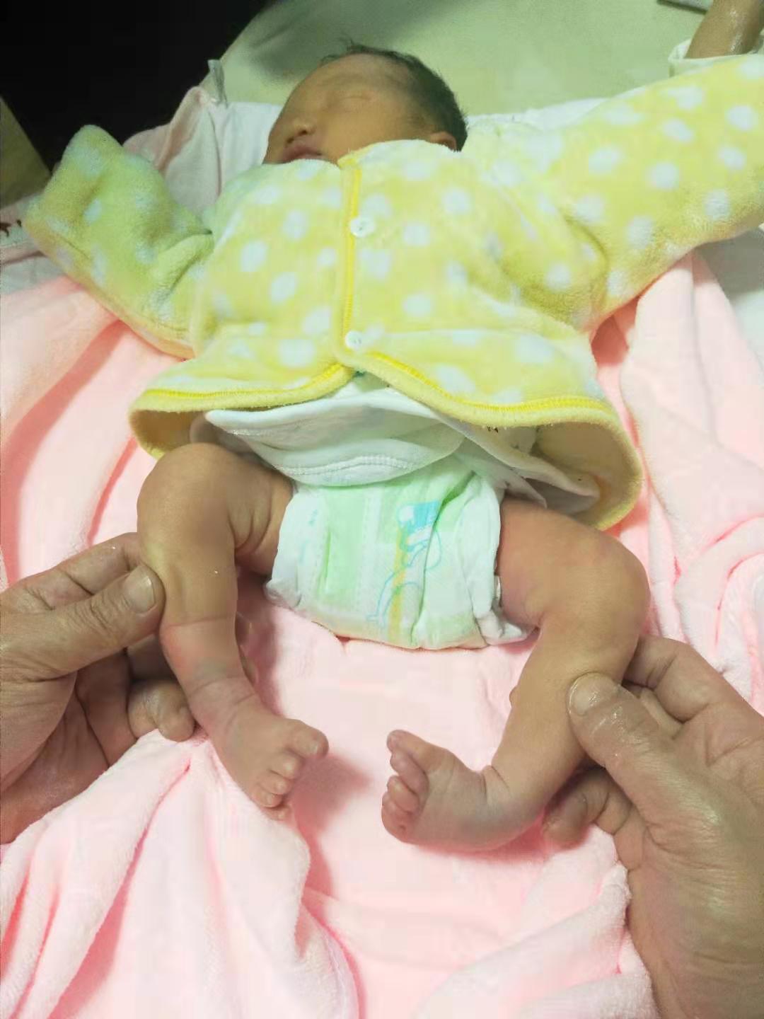 严重马蹄足内翻胎儿能要吗,孕期发现严重的足内翻需要引产吗