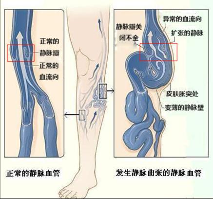 小腿老是发麻有沉重感看什么科,下肢腿部沉重是什么原因造成的