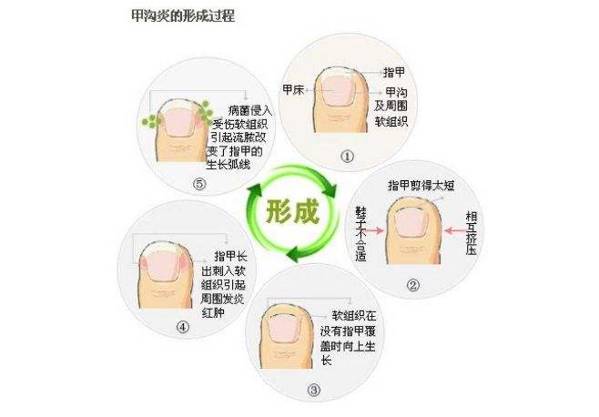 得甲沟炎最有效的处理方法是什么,甲沟炎怎么初期治疗才能彻底根除