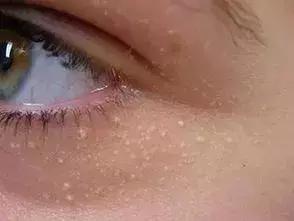 老中医教你一招彻底解决脂肪粒,肚子里面有脂肪粒怎么解决