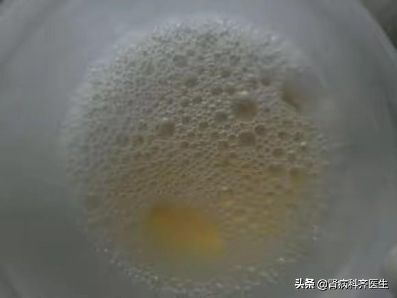 iga肾病的治疗方法大全,iga肾病有什么好的治疗方法