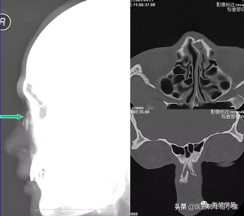 「鼻骨彩图」鼻骨CT解剖及骨折影像学诊断
