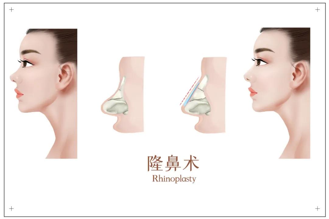 怎样才算是最美的鼻子,颜值最高的四种鼻子型