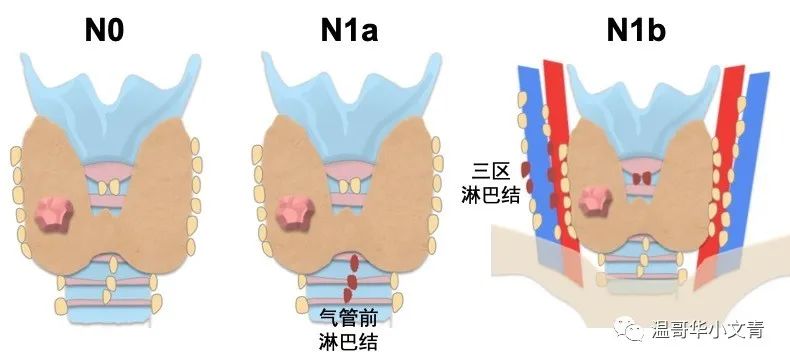分化型甲状腺癌的分期及生存率,如何判定得了甲状腺癌