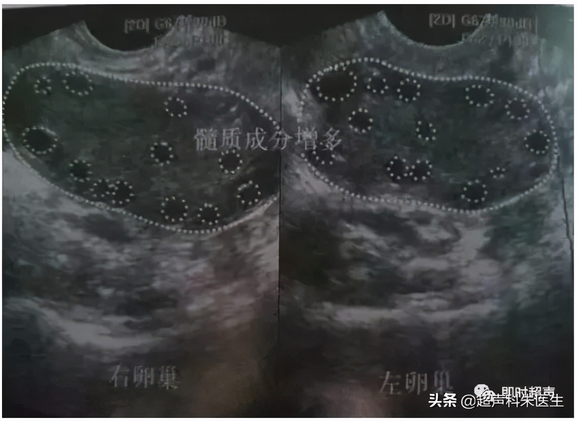妇科超声的标准超声图,妇科超声图解