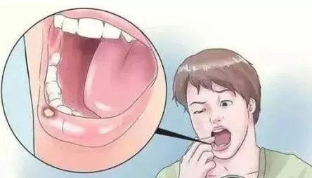 口腔经常有口疮或溃疡是什么原因,起口疮后来成了口腔溃疡怎么治