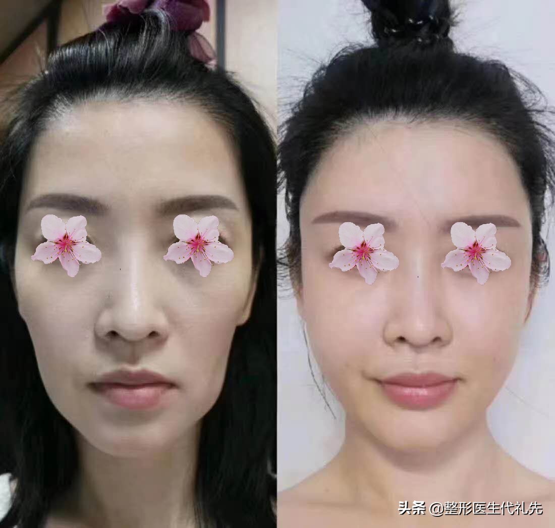 怎样填充太阳穴不显脸宽,怎样填充太阳穴和额头