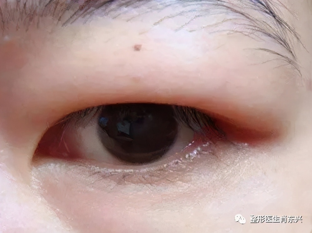 双眼皮埋线和割双眼皮有什么区别,除了割双眼皮怎么可以变成双眼皮