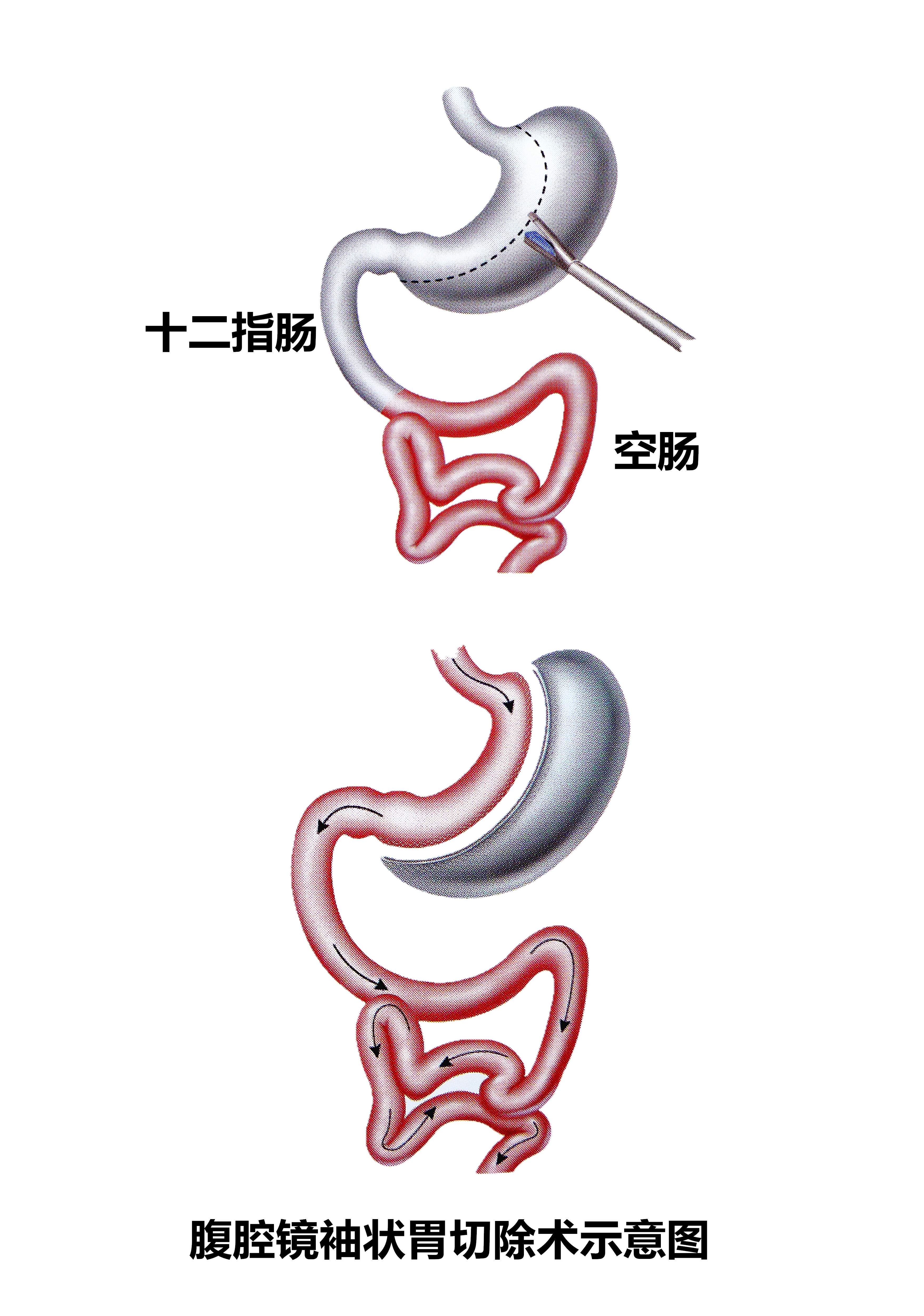 切掉一部分胃可以减肥吗,切掉半个胃能减多少斤