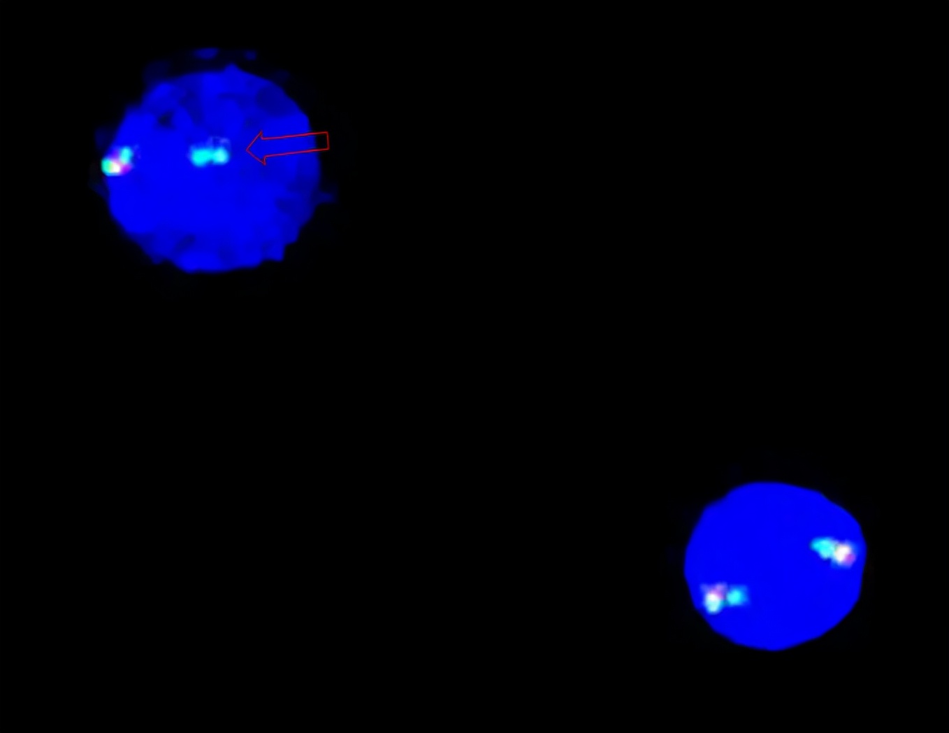 嗜酸性粒细胞高咳嗽,咳嗽嗜酸性粒细胞高是什么原因