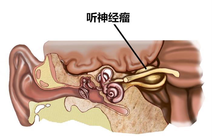 听神经瘤--保面or保听？