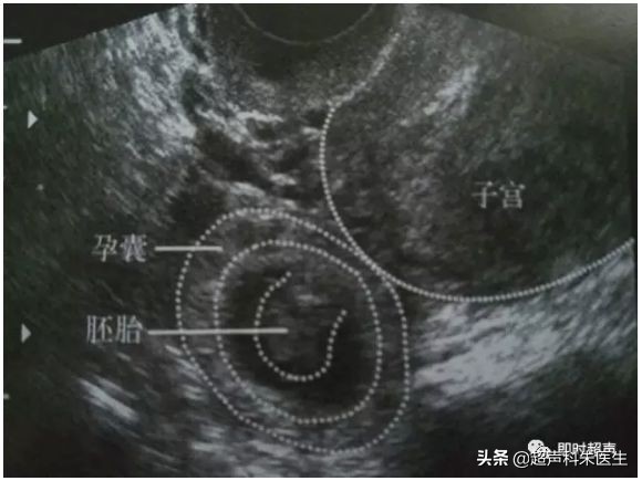 妇科超声的标准超声图,妇科超声图解