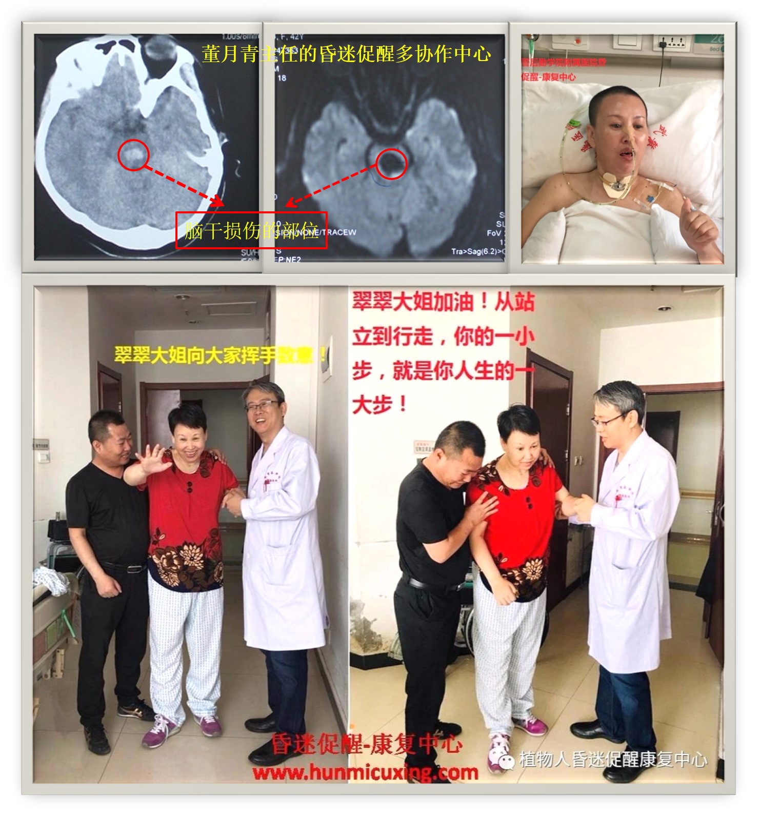 脑干出血昏迷不醒呼吸声音大,脑干出血昏迷不醒有多严重