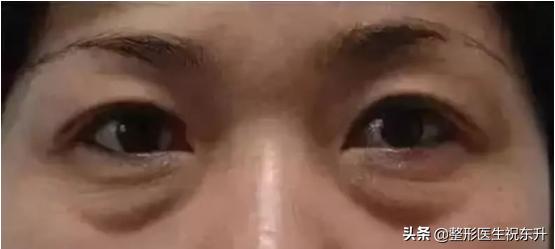 做眼袋用什么护肤品,眼袋大怎么办用什么眼霜好