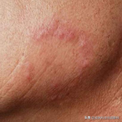 脸上成片斑是哪里出了问题,脸上痘印变成癣了怎么回事
