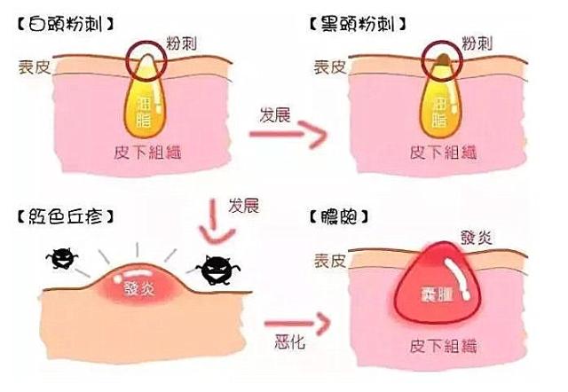 闭口反反复复长到底怎样才能根治,闭口反反复复长怎么办
