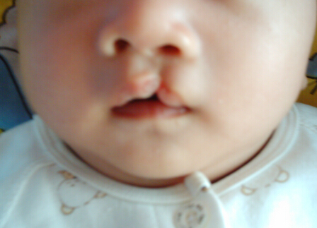 兔唇孩子是孕妇吃兔子造成的吗,吃兔子肉生下来的孩子会长兔唇吗