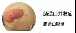 墙裂建议收藏！肠造口回缩，脱垂，旁疝，出血，水肿你会处理吗？