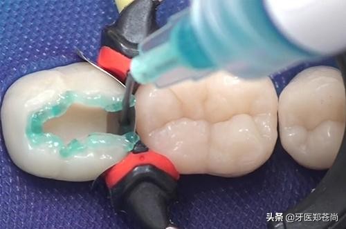 牙齿蛀牙了，补牙用什么材料的好？