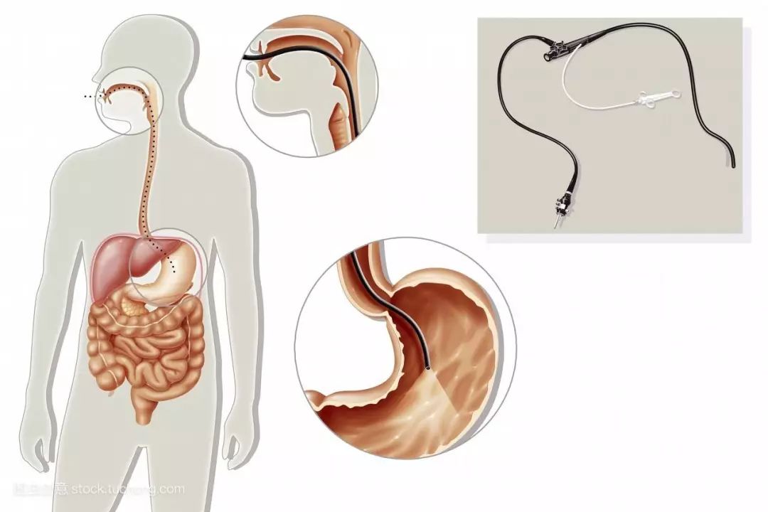 关于胃镜的那些事儿,关于胃镜的图片大全