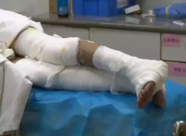 过生日被烫伤意味着什么,大学生吃火锅被烧伤