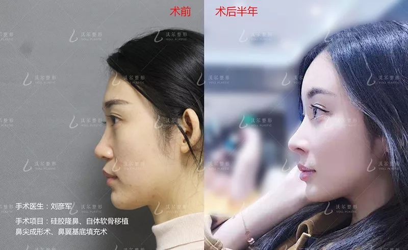 12月4日下午2点直播预告｜“嘴凸被说成猿人”到底该正畸还是做鼻子？