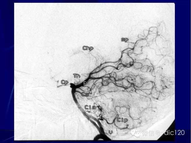 脑血管解剖技巧,脑血管解剖与介入
