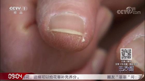 一到冬天手脚起皮干裂怎么治,冬天手脚干裂一招轻松缓解