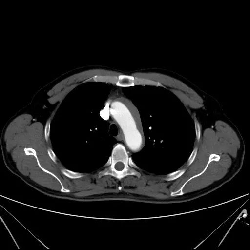 胸痛偶尔还会伴有响声,胸痛并伴有咽喉有异物感
