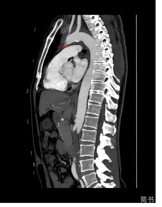 胸痛偶尔还会伴有响声,胸痛并伴有咽喉有异物感