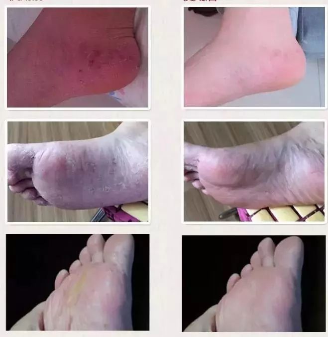 脚气湿疹止痒最快的软膏,湿疹止痒膏可以治脚气吗