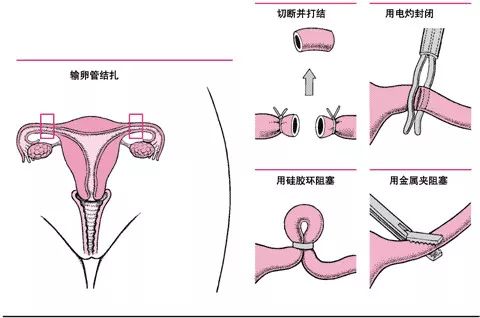 与男友共度这一夜后，24岁女孩差点……（附避孕科普）