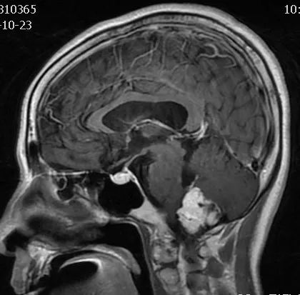 影像病例学习（3）：后颅窝实性占位病变