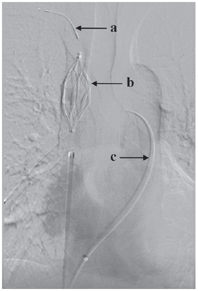 picc置管术后血栓形成处理,picc置管出现血栓后医院怎么溶栓